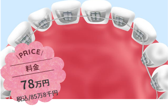 裏側矯正