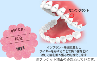 ミニインプラント矯正